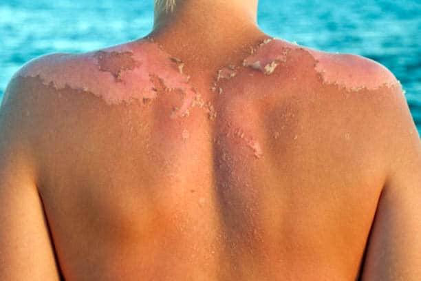 7 sun safety tips for the south african summer sun burn