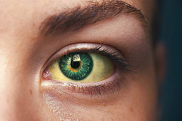 world hepatitis day 28 july 2022 wellness newsletter yellowing of eyes